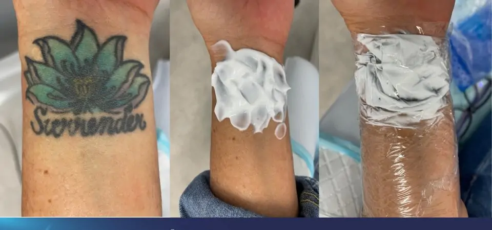 numbing cream tattoo removal