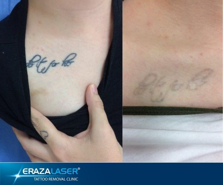 Tattoo Removal
