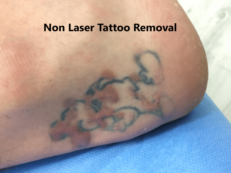 non laser tattoo removal