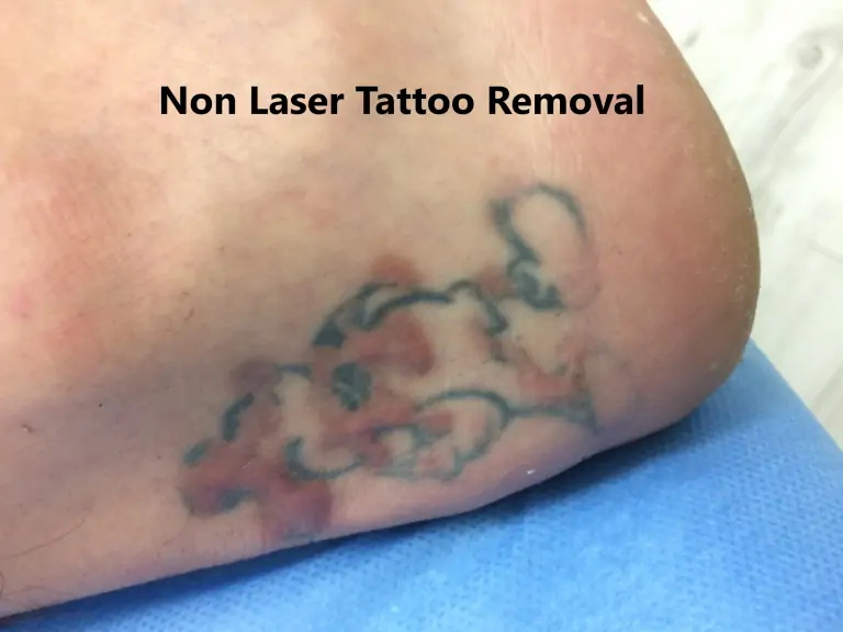 non laser tattoo removal