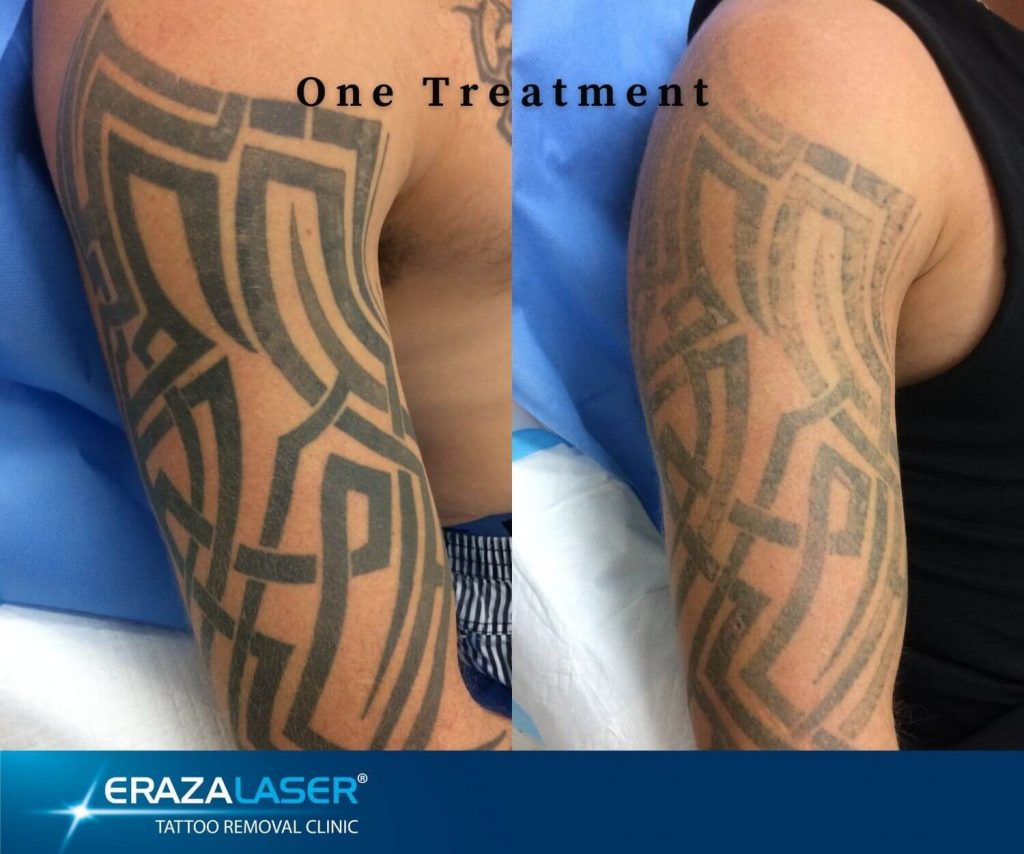 Tattoo Removal Southport