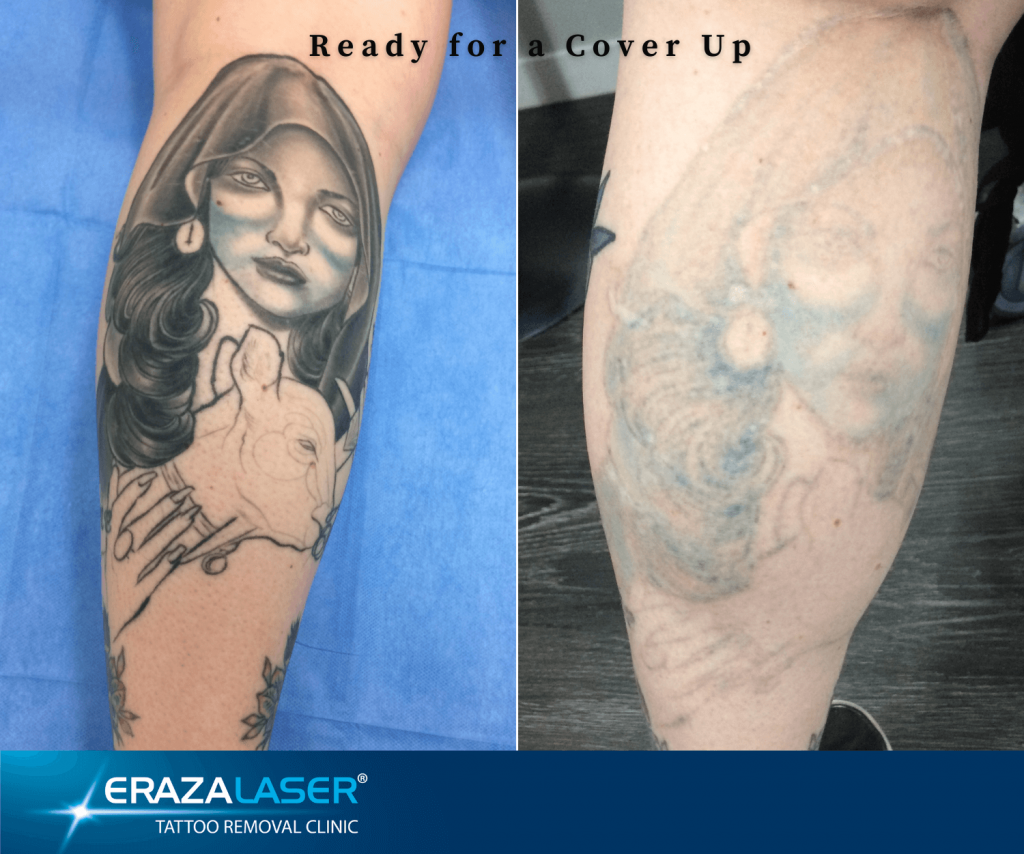 Tattoo Removal Townsville