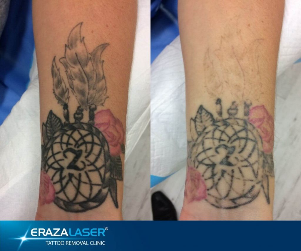 Partial tattoo removal 1st session picosure : r/TattooRemoval