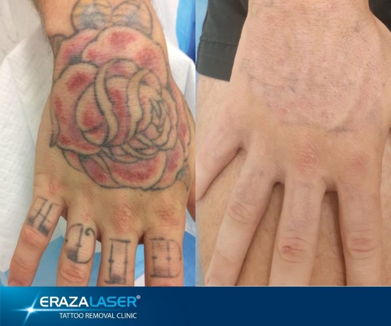 Tattoo Removal Training Theory ERAZALASER College