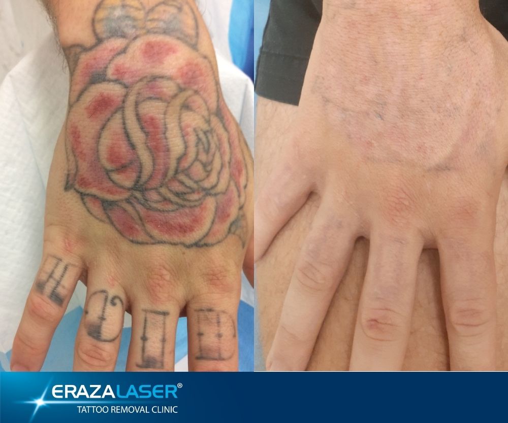Tattoo Removal Images Before and After Photos - ERAZALASER Clinics