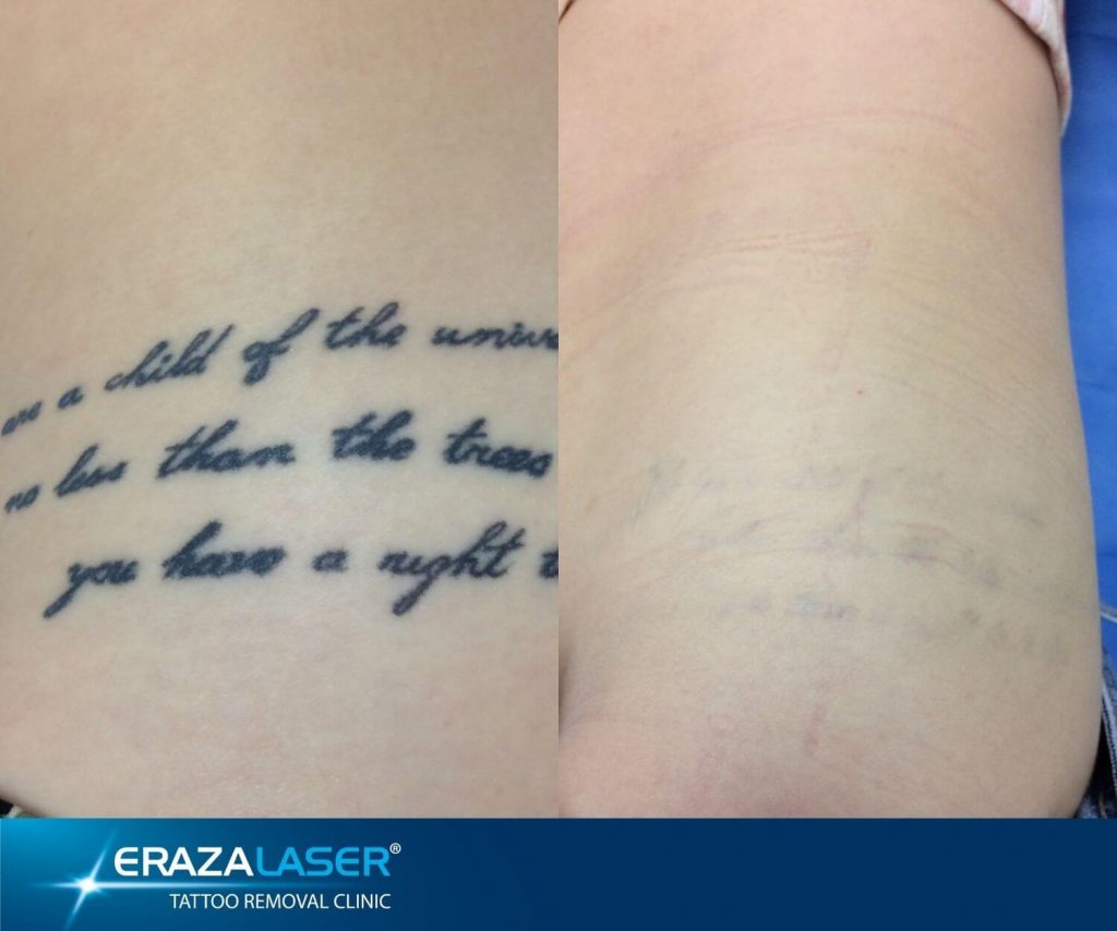 Tattoo Removal Images  Laser Training International