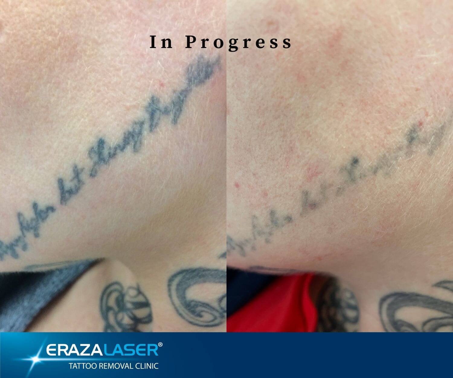2 session progress on this... - Laser Tattoo Removal Scotland | Facebook