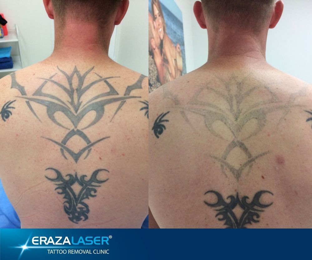 Laser tattoo Removal | Tattoos, Laser tattoo, Laser tattoo removal