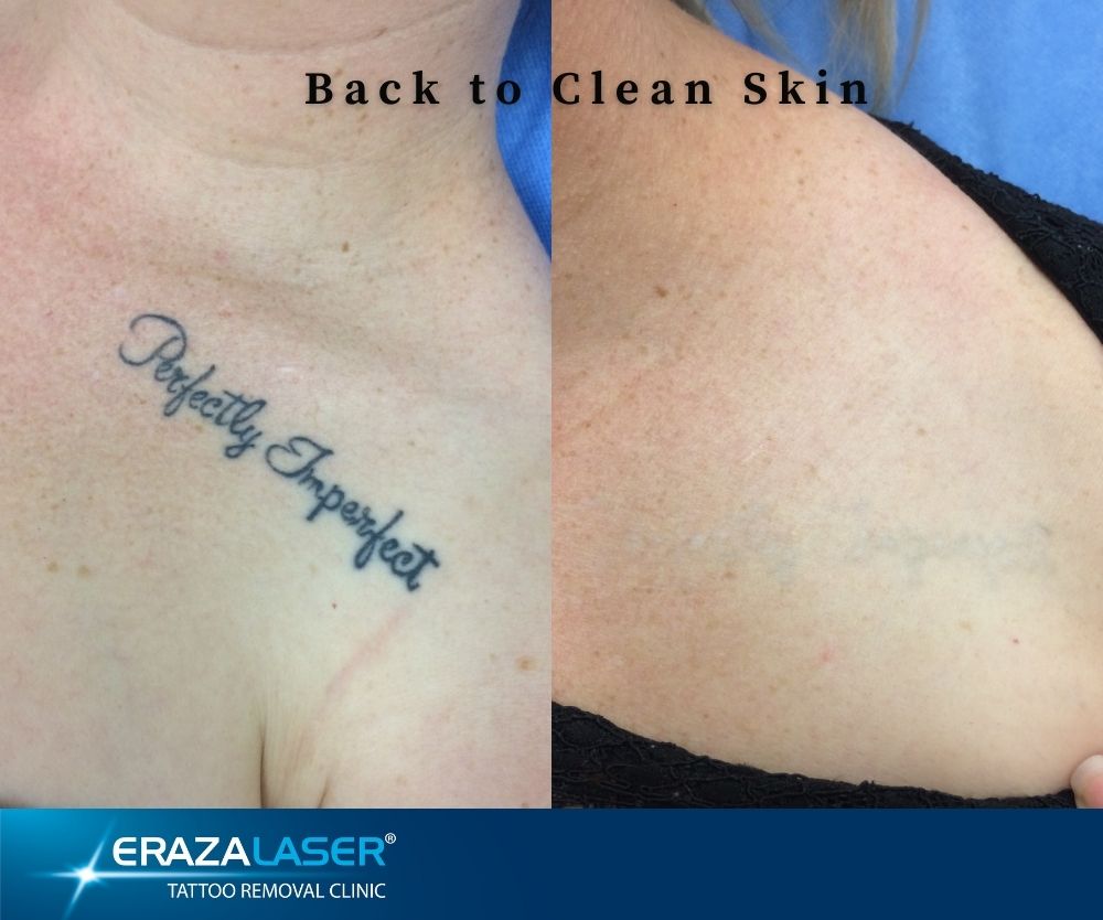Laser Tattoo Removal Before and After Photos